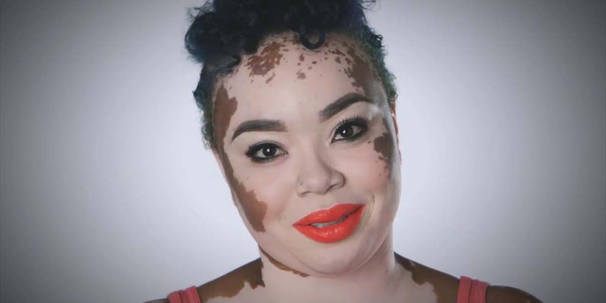 Renkli insan hastalığı vitiligonun oluşumu, tedavisi ve bazı öneriler